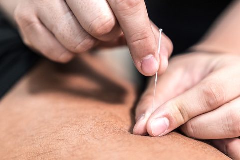 Acupuncture